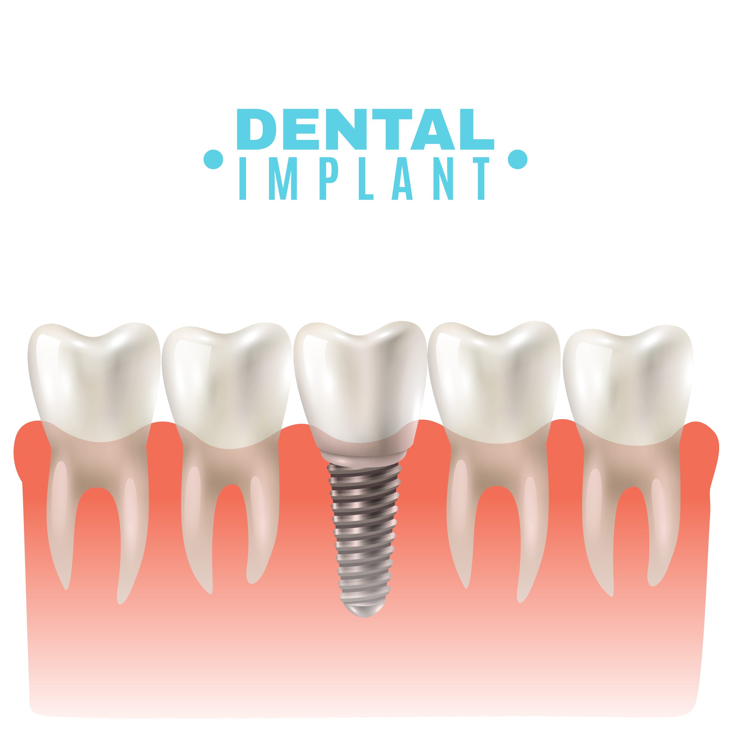 dental impants in mississauga