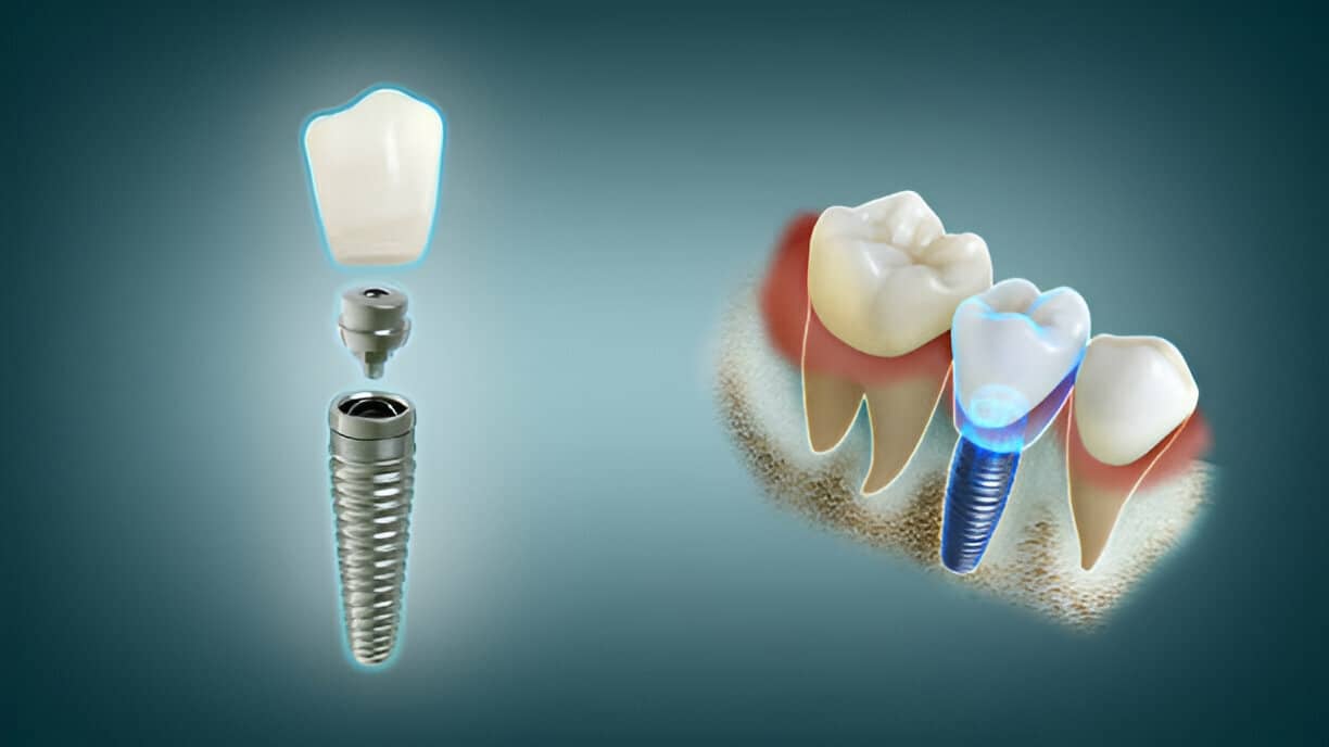 Restore Your Smile: Top Benefits of Dental Implants
