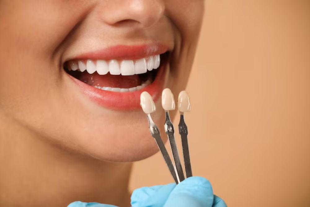 dental-veneers-explained-how-they-work-and-who-can-benefit