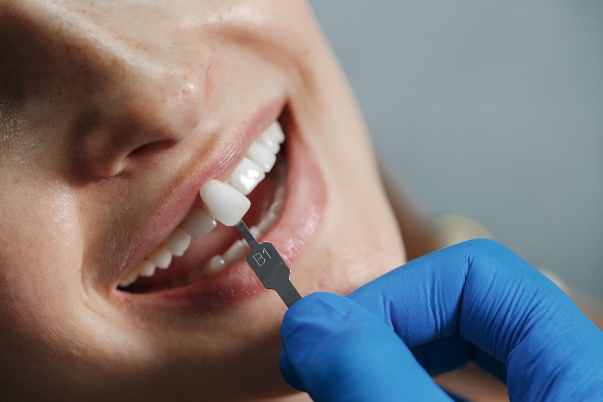 How Much Do Porcelain Veneers Cost Per Tooth in Mississauga, and How Long Do They Last?