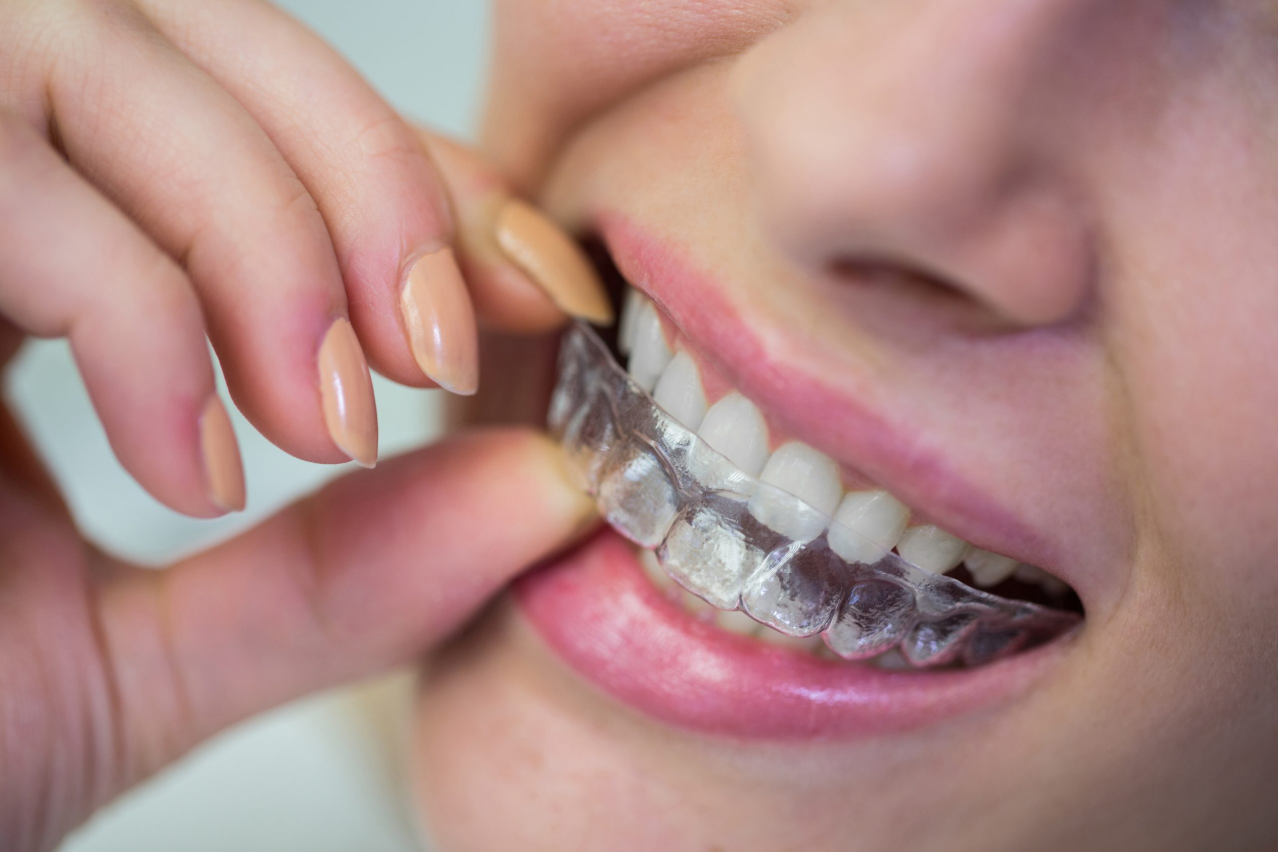 How Invisalign Can Help You Achieve a Straighter Smile