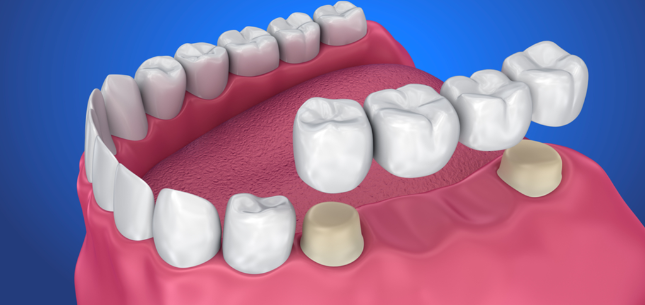Dental bridges in Mississauga